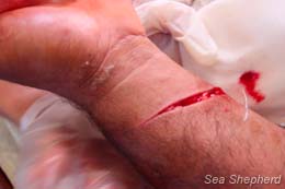 The injured fisherman’s deep wound. Photo: Simon Ager